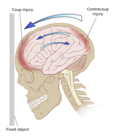 concussion